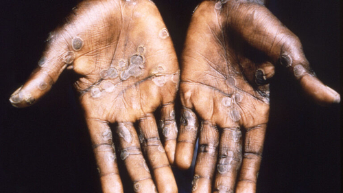 Latest company news about La manifestation de Monkeypox pose “le risque modéré” à la santé publique globale, l'OMS dit